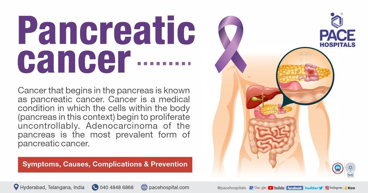 Pancreatic Cancer Symptoms Dana Farber Cancer Institute 53 OFF